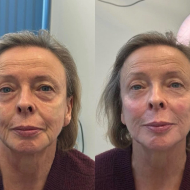 Full Face Harmony before and after at Lunè Luxe
