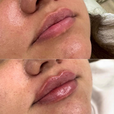 Lip Filler before and after at Lunè Luxe
