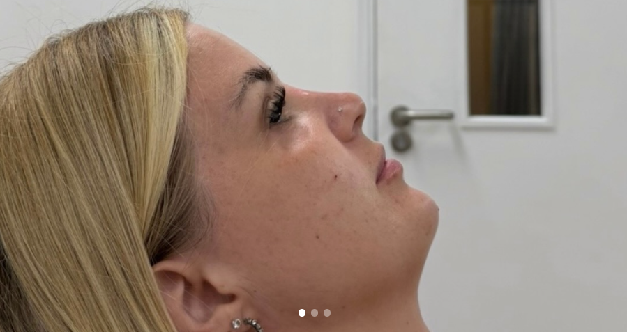 Balanced profile result at Lunè Luxe Aesthetics
