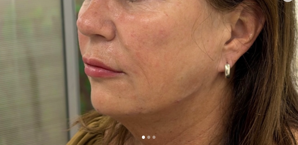 Sculpted jawline result at Lunè Luxe Aesthetics
