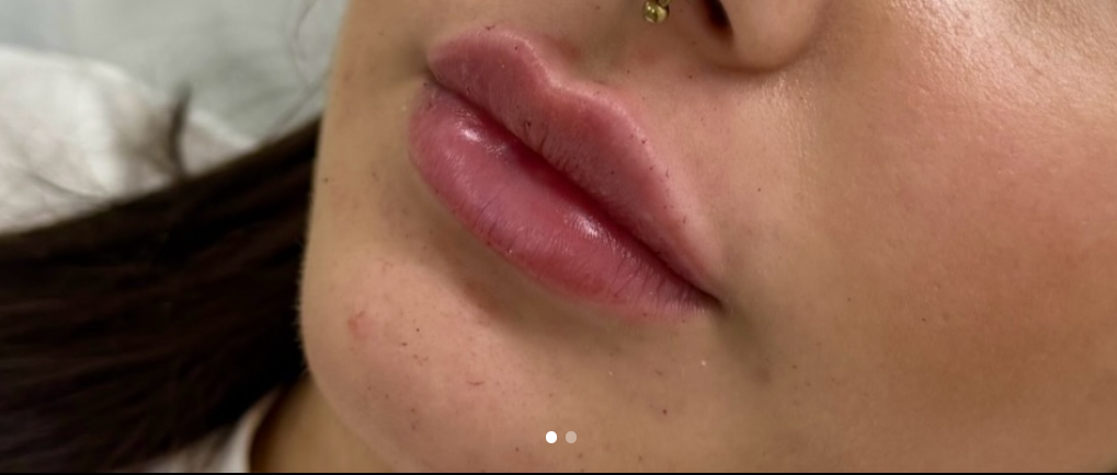 1ml lip enhancement result at Lunè Luxe Aesthetics